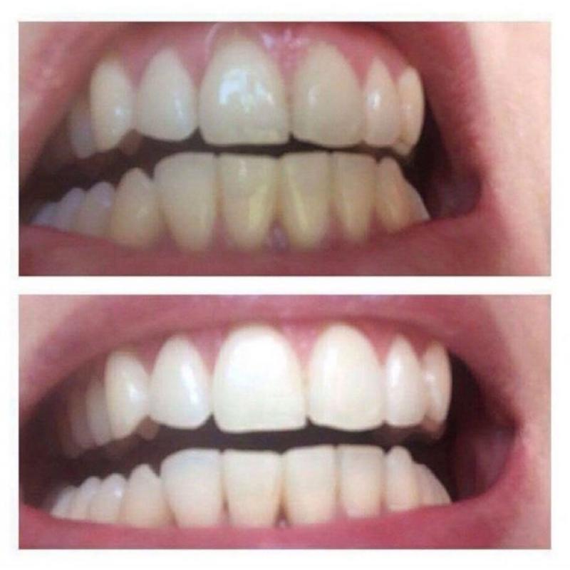 Teeth whitening