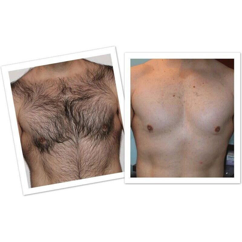 MENS PERMANENT LASER HAIR REMOVAL