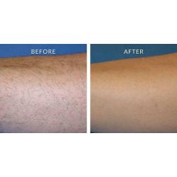 MENS PERMANENT LASER HAIR REMOVAL